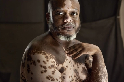 Image person with vitiligo looking at camera