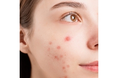 Image A closeup shot of a woman's facial acne.