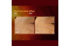 Image Before and after images of fine line improvement around eyes.