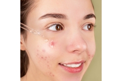 Image smiling girl with acne on cheek applies serum with dropper
