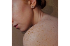 Image A womans shoulder with freckles.