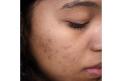 Image A woman with acne bumps on her cheek.
