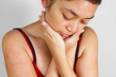 Image Woman with sensitive skin