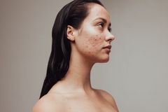 Image A woman with acne on her cheek looking to the side.