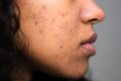 Image Woman with hyperpigmentation on her skin