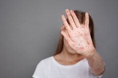 Image A young girl with measles on her hands and neck holds her hand over her face.