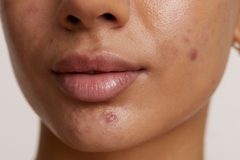Image woman with acne