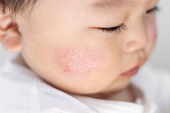 Eczema rash on baby's cheek