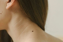 woman with hair over shoulder showing mole in neck