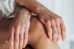 woman with hands crossed over knees with eczema