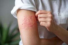 Image girl with contact allergy from cosmetics