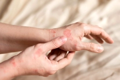 Itching on hands with redness rash.