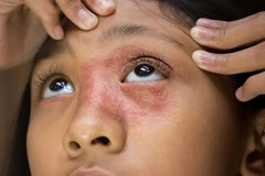 Image A young girl with a redness and dryness around her eye.