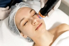 woman getting microneedle treatment