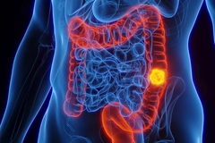 Image Colorectal cancer illustration