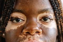 Woman with vitiligo in her face