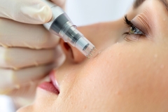 Person having microneedling done.