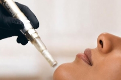 Image SkinStylis PR image, microneedling