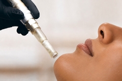 Image Person receiving micro needling.