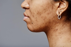 Image Person with acne pigmentation.