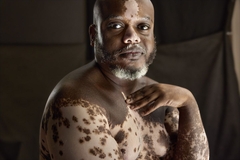 Image person with vitiligo looking at camera