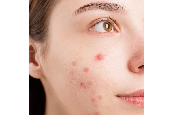 Image A closeup shot of a woman's facial acne.