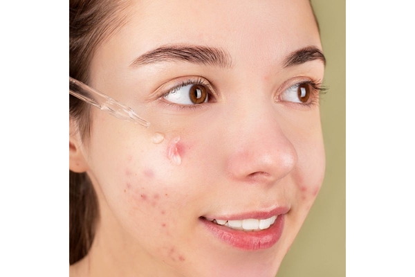 smiling girl with acne on cheek applies serum with dropper