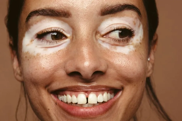 Image Woman with skin spots smiling