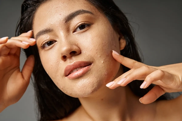 Image A woman with slight acne touching her face.